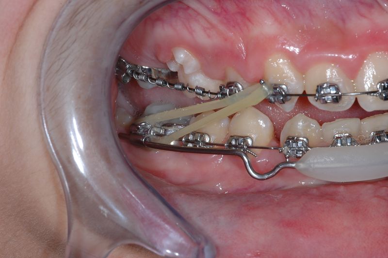 File:Caso clinico di 2° Classe con deep bite (2) - 1st phase of OrthoNeuroGnatodontic treatment (001).jpg