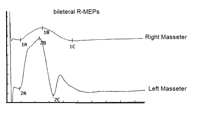 File:Meningioma 3 by Gianni Frisardi.jpg