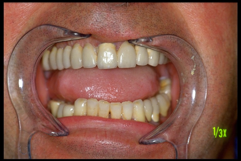 File:Meningioma 6 by Gianni Frisardi.jpg