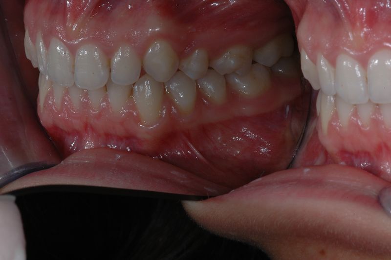 File:Final left view of Invisible OrthoNeuroGnathodontic treatments (mirror).jpg
