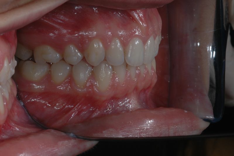 File:Final right view of Invisible OrthoNeuroGnathodontic treatments.jpg