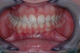 Occlusion in young lady, needing attention.jpg