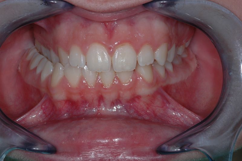 File:Occlusion in young lady, needing attention.jpg