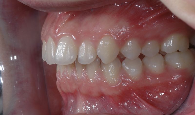 File:Invisible OrthoNeuroGnathodontic before treatments (left side).jpg