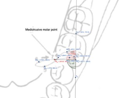 Figura 4: Distanze tra i punti mediotrusivi molari