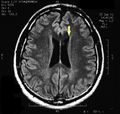 Pineal cavernoma post surgery 1.jpeg