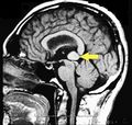 Pineal cavernoma pre surgery 2.jpg