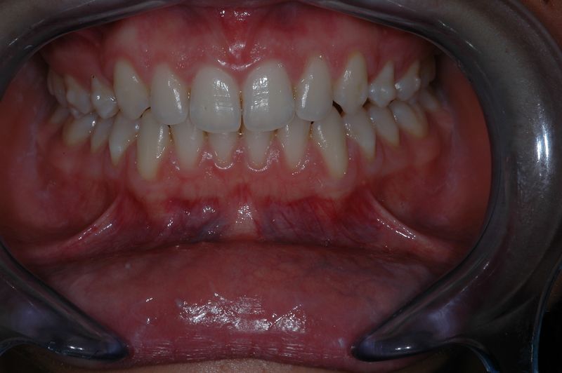 File:Frontal view of Invisible OrthoNeuroGnathodontic treatments.jpg
